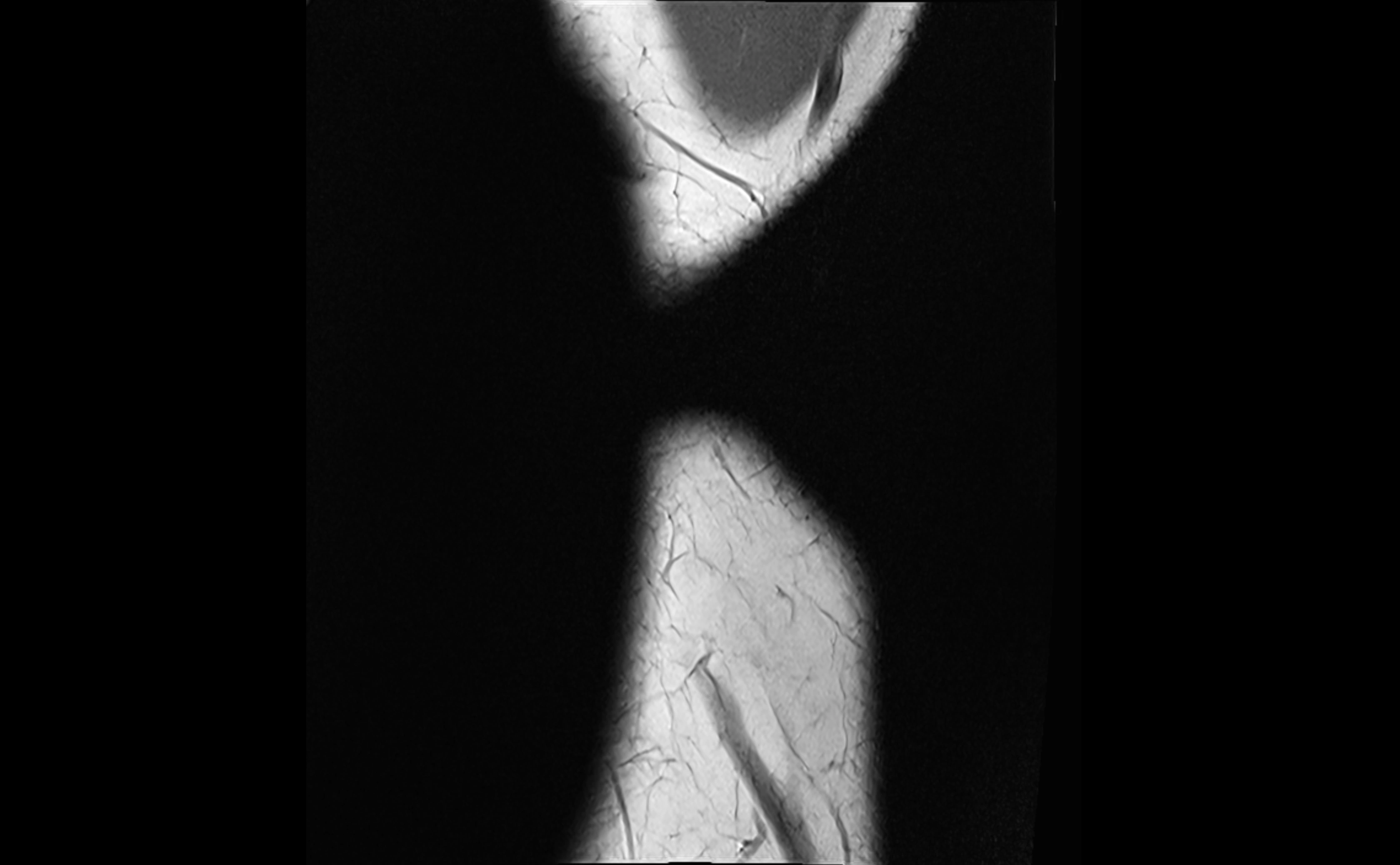 MRI elbow ligaments coronal cross sectional anatomy 3T  radiology  image-img-07001-00002.webp